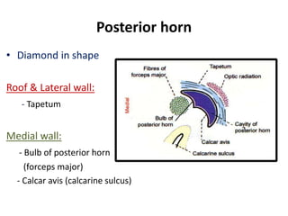 Posterior horn
• Diamond in shape
Roof & Lateral wall:
- Tapetum
Medial wall:
- Bulb of posterior horn
(forceps major)
- Calcar avis (calcarine sulcus)
 