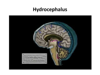 Hydrocephalus
 