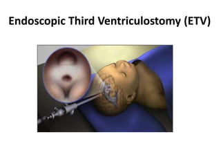 Endoscopic Third Ventriculostomy (ETV)
 