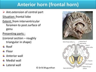 Anterior horn (frontal horn)
 Ant.extension of central part
Situation: frontal lobe
Extent: from interventricular
foramen...