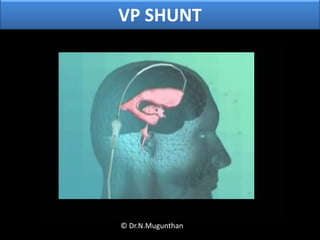 VP SHUNT
© Dr.N.Mugunthan
 