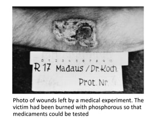 Photo of wounds left by a medical experiment. The
victim had been burned with phosphorous so that
medicaments could be tested
 