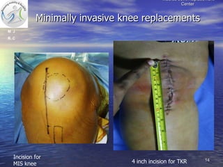 Mis Incision Latest Advances In Joint Replacement & Knee Implant | PPT