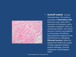 • Aschoff nodule of acute
rheumatic fever. The nodule is
composed of Anitschkow cells;
these have clear nuclei with a
central bar of chromatin, said to
resemble a caterpillar. There is a
central area of fibrin. This central
necrosis is further surrounded by
a mononuclear cell infiltrate.
Myocardial fibres adjacent to the
Aschoff body are undergoing
Fibrinoid necrosis. (Sebire NJ,
Ashworth M, Malone M, Jacques
TS [eds]: Diagnostic Pediatric
Surgical Pathology. Churchill
Livingstone, United Kingdom,
2010.)
Latest developments in rheumatic fever
 