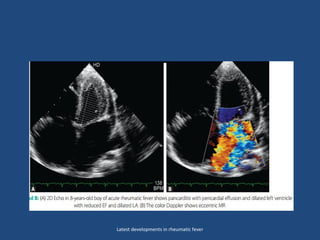 Latest developments in rheumatic fever
 