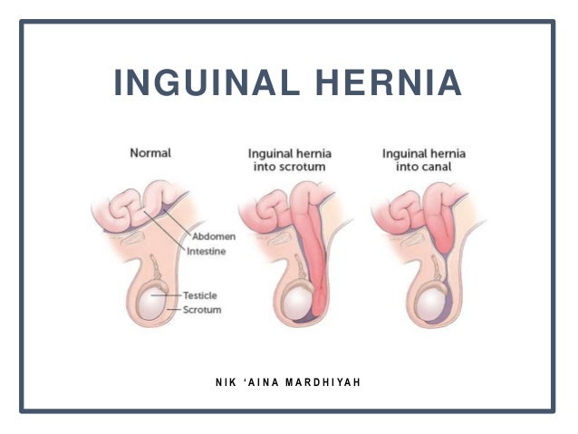 Inguinal Hernia Pediatric Urology Andromedic Academy Belgrade