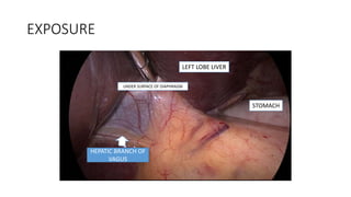 EXPOSURE
LEFT LOBE LIVER
UNDER SURFACE OF DIAPHRAGM
STOMACH
HEPATIC BRANCH OF
VAGUS
 