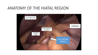 ANATOMY OF THE HIATAL REGION
CAUDATE
LOBE
LEFT GASTRIC
PEDICLE
STOMACH
LEFT LOBE LIVER
HEPATIC BRANCH
OF VAGUS
 