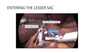 ENTERING THE LESSER SAC
GASTRO HEPATIC
LIGAMENT
KUTZNER WINDOW
LEFT LOBE LIVER
UNDER SURFACE OF DIAPHRAGM
 