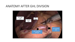 ANATOMY AFTER GHL DIVISION
LEFT LOBE
LIVER
CAUDATE
LOBE
LEFT GASTRIC
ARTERY
LEFT GASTRIC
VEIN
RT
CRUS
 