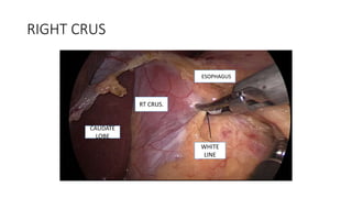 RIGHT CRUS
RT CRUS.
WHITE
LINE
CAUDATE
LOBE
ESOPHAGUS
 