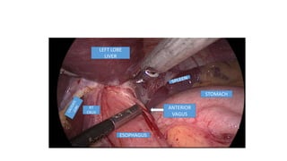 ANTERIOR
VAGUS
STOMACH
ESOPHAGUS
RT
CRUS
LEFT LOBE
LIVER
 