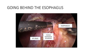 GOING BEHIND THE ESOPHAGUS
PHRENO
ESOPHAGEAL
MEMBRANE
ESOPHAGUS
RT CRUS
 