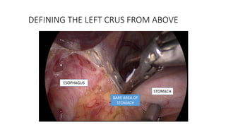 DEFINING THE LEFT CRUS FROM ABOVE
BARE AREA OF
STOMACH
STOMACH
ESOPHAGUS
 