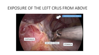 EXPOSURE OF THE LEFT CRUS FROM ABOVE
INFERIOR PHRENIC VESSEL
STOMACH
ESOPHAGUS
BARE AREA OF STOMACH
 