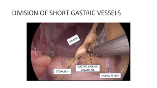 DIVISION OF SHORT GASTRIC VESSELS
SPLENIC ARTERY
GASTRO SPLENIC
LIGAMENTSTOMACH
 