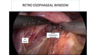 RETRO ESOPHAGEAL WINDOW
RETRO
ESOPHAGEAL
WINDOW
RT
CRUS
 