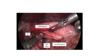 POSTERIOR VAGUS
ESOPHAGUS
RT
CRUS
LEFT
CRUS
 