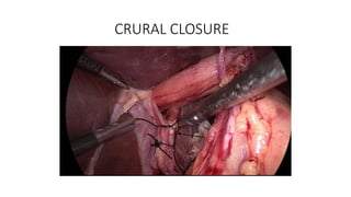 CRURAL CLOSURE
 