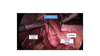 FUNDAL
WRAP
CAUDATE
LOBE
ESOPHAGUS
FUNDUS
 