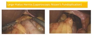 Large Hiatus Hernia.(Laparoscopic Nissen’s Fundoplication)
 