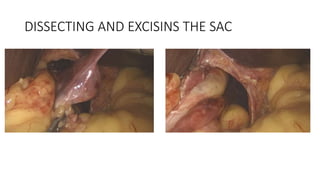 DISSECTING AND EXCISINS THE SAC
 
