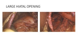 LARGE HIATAL OPENING
 