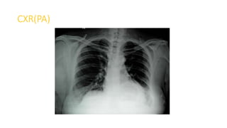 CXR(PA)
 