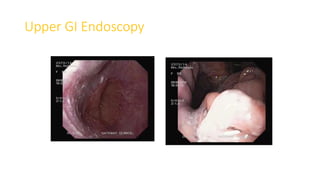Upper GI Endoscopy
 