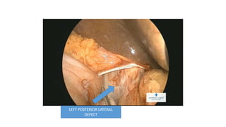 LEFT POSTERIOR LATERAL
DEFECT
 