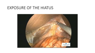 EXPOSURE OF THE HIATUS
 