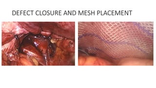 DEFECT CLOSURE AND MESH PLACEMENT
 