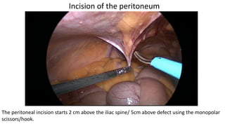 Incision of the peritoneum
The peritoneal incision starts 2 cm above the iliac spine/ 5cm above defect using the monopolar
scissors/hook.
 