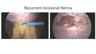 Recurrent Incisional Hernia
 
