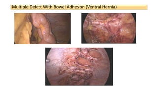 Multiple Defect With Bowel Adhesion (Ventral Hernia)
 