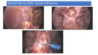 Ventral Hernia With Bowel Adhesions
 