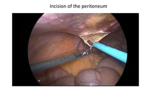 Incision of the peritoneum
 