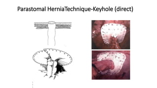 Parastomal HerniaTechnique-Keyhole (direct)
1
5
1
 