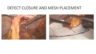 DEFECT CLOSURE AND MESH PLACEMENT
 