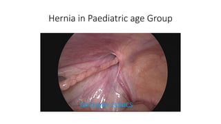 Hernia in Paediatric age Group
 