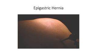 Epigastric Hernia
 