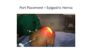 Port Placement – Epigastric Hernia
 