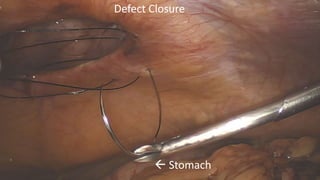 Defect Closure
 Stomach
 