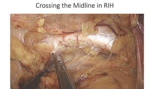 Crossing the Midline in RIH
 