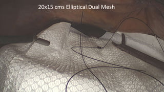 20x15 cms Elliptical Dual Mesh
 