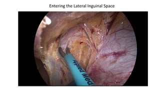 Entering the Lateral Inguinal Space
 