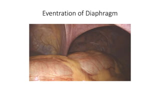 Eventration of Diaphragm
 