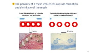 1mm 1.5mm
The porosity of a mesh influences capsule formation
and shrinkage of the mesh
Optimal porosity provide sufficient
space for tissue ingrowth
Poor porosity leads to capsule
formation and shrinkage
3
216
 