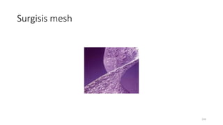 Surgisis mesh
239
 