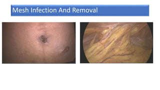 Mesh Infection And Removal
 